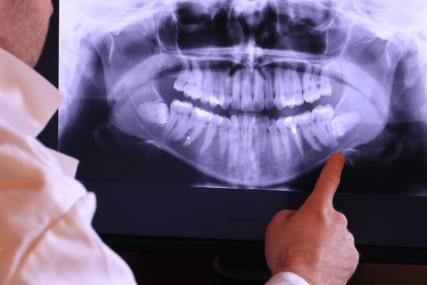 Best Emergency Wisdom Tooth Extraction in Lealman, FL
